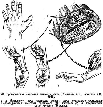 Анестезия по брауну