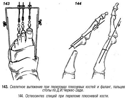 Спицы в пальце при переломе. Вытяжение кости при переломе. Остеосинтез 5 плюсневой кости. Скелетное вытяжение кисти при переломе. Скелетное вытяжение при переломах костей кисти.