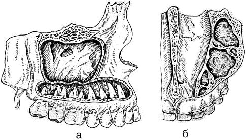 Стенки пазух. Стенки гайморовой пазухи анатомия. Стенки верхнечелюстной пазухи анатомия. Взаимоотношение корней зубов и дна верхнечелюстной пазухи. Верхняя челюсть верхнечелюстная пазуха.