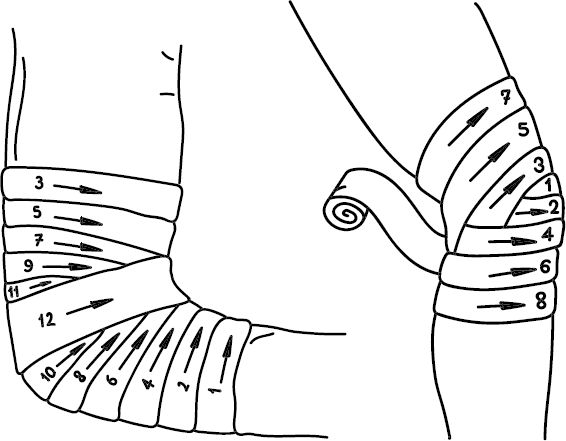 Перевязка локтя. Сходящаяся черепашья повязка. Бинтование локтевого сустава эластичным бинтом. Черепашья повязка на локтевой сустав. Черепашья сходящаяся на локтевой сустав повязка.