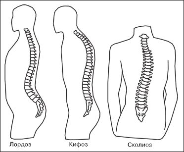 Сколиоз остеохондроз позвоночника. Лордоз и кифоз. Кифоз лордоз и сколиоз позвоночника. Искривление позвоночника лордоз кифоз сколиоз. Кифоз кифоз лордоз позвоночника.