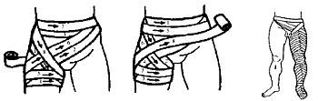 Спиральная с перегибами. Спиралевидная повязка на голень. Спиралевидная повязка с перегибами. Перевязка спиральная на бедро. Спиральная повязка с перегибами на бедро.